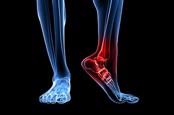 Causes of Broken Heels