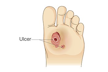 Treating Chronic Diabetic Foot Ulcers