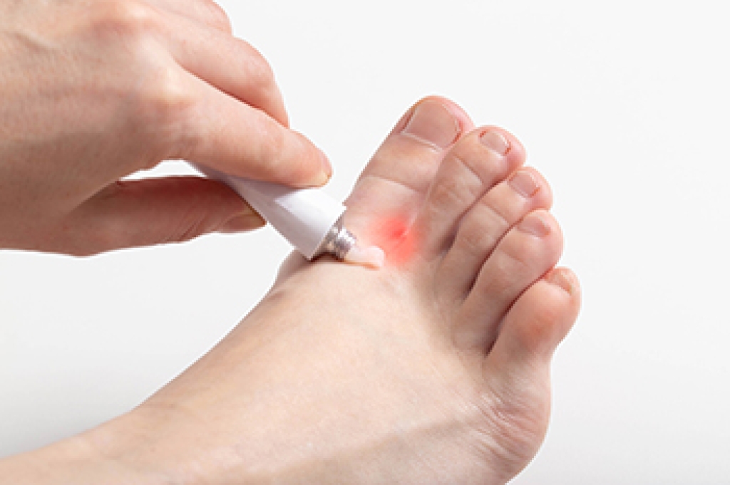 Understanding Athlete's Foot and How It Is Treated