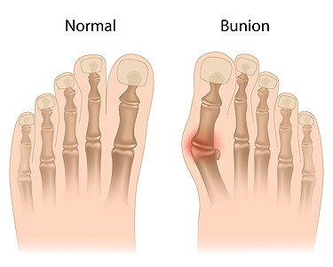 Do orthotics help bunions sales