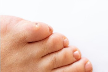 Causes and Common Locations of Seed Corns