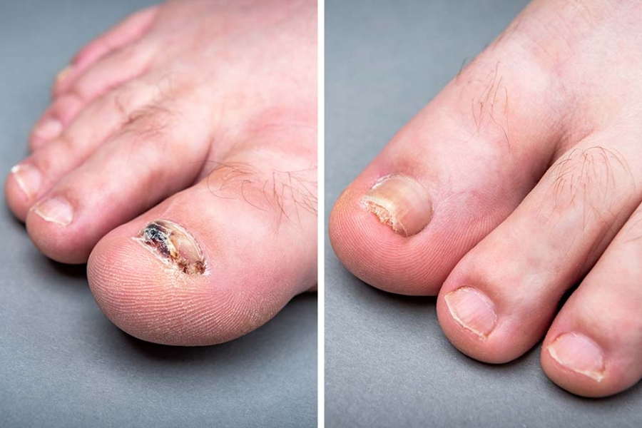Toenail Fungus During Pregnancy Remedies And Treatment